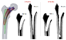 Bone Remodeling Following Total Hip Replacement: Short Stem Versus Long ...