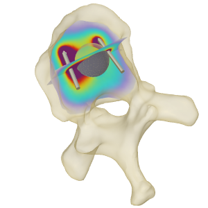 Optimization of electrochemotherapy treatment parameters in 3D anatomical ...