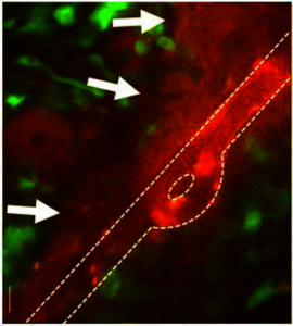 Mathematical Modeling of Drug Transport in Brain Tumors
