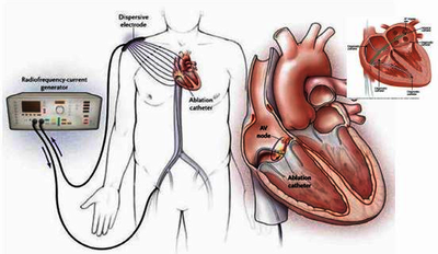 Design of Radio-Frequency Ablation Catheter